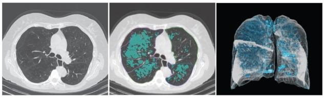 CT scans for emphysema