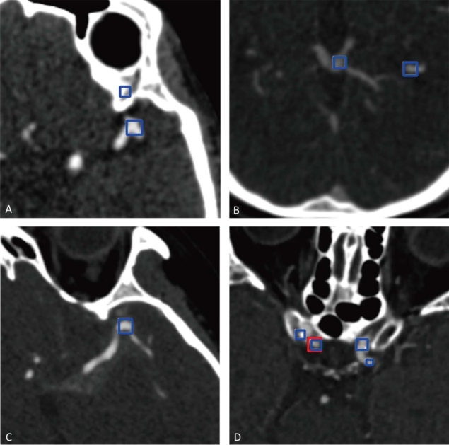 Examples of false-positive aneurysms