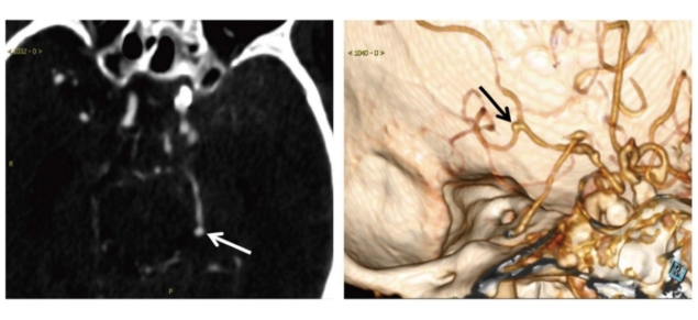 Aneurysm detection