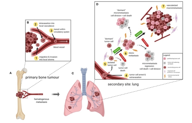 Bone cancer metastasis