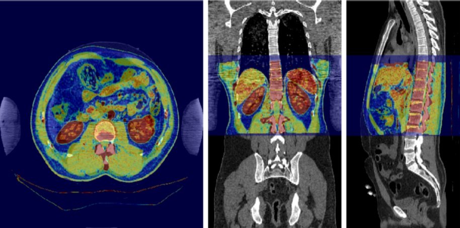 Machine learning for tomographic imaging - Physics World