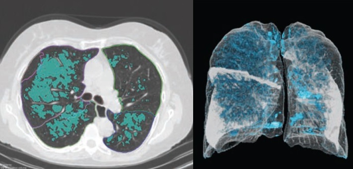 AI can enhance accuracy of CT scans in emphysema - Physics World