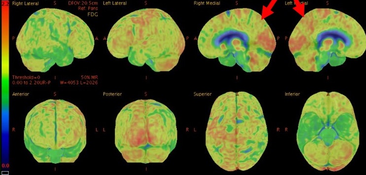 FDG-PET displays its prowess in dementia detection - Physics World