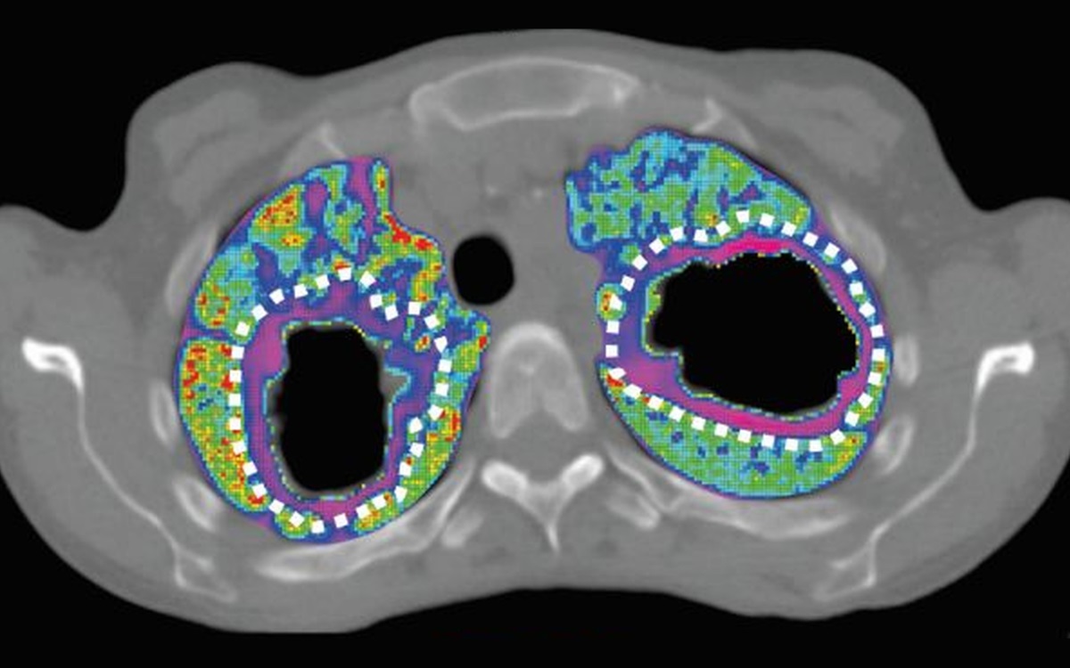 PET scans could help develop shorter TB treatments - Physics World