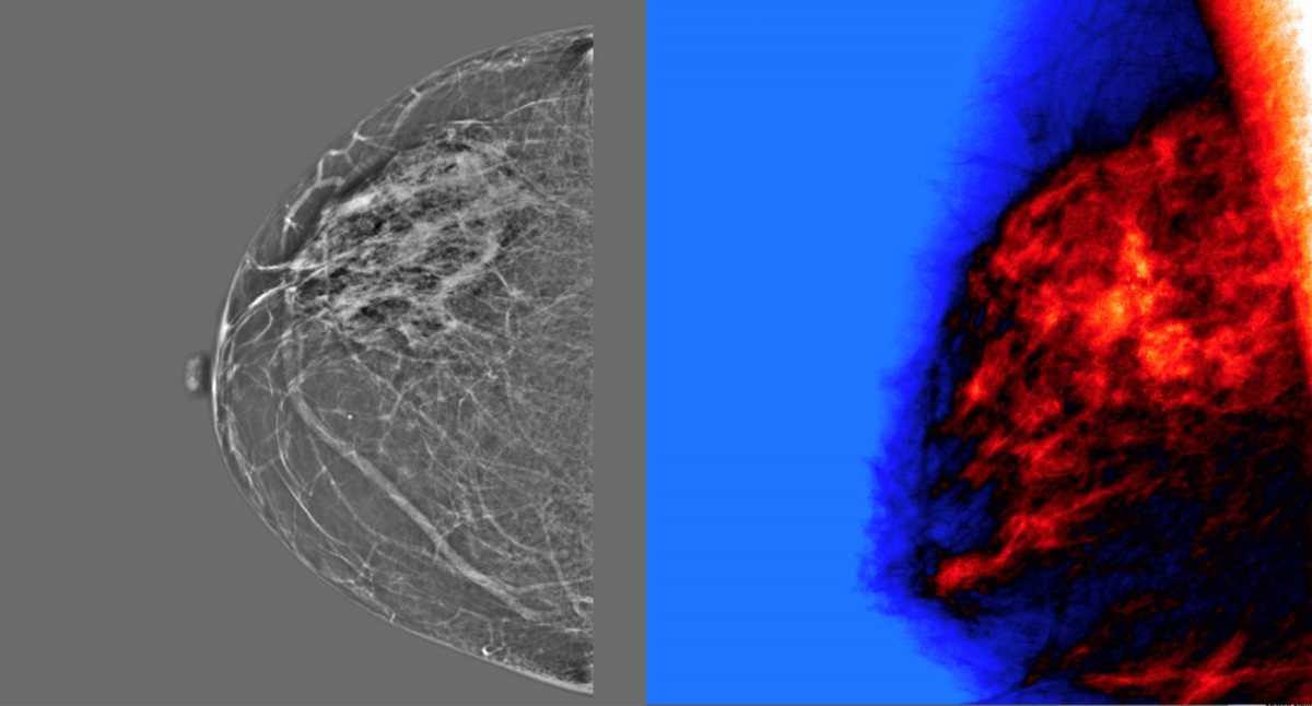 Crowdsourced AI challenge aims to improve mammography accuracy - Physics World