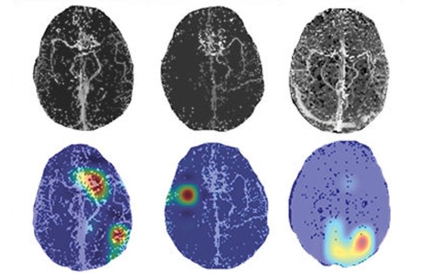 Deep learning enables rapid detection of stroke-causing blockages - Physics World